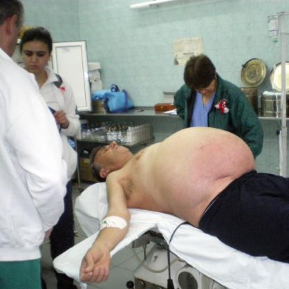 Хасковски хирурзи отстраниха 30-килограмова ехинококова киста от черния дроб на 51-годишен мъж