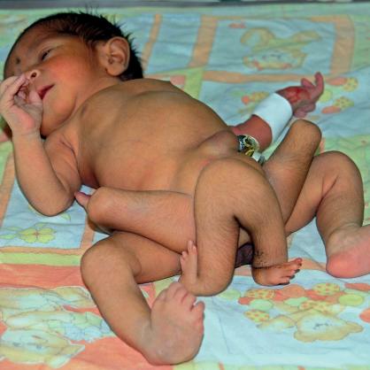 Шесткракото бебе, родено в Пакистан