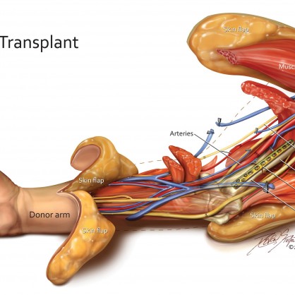 Трансплантация на ръце