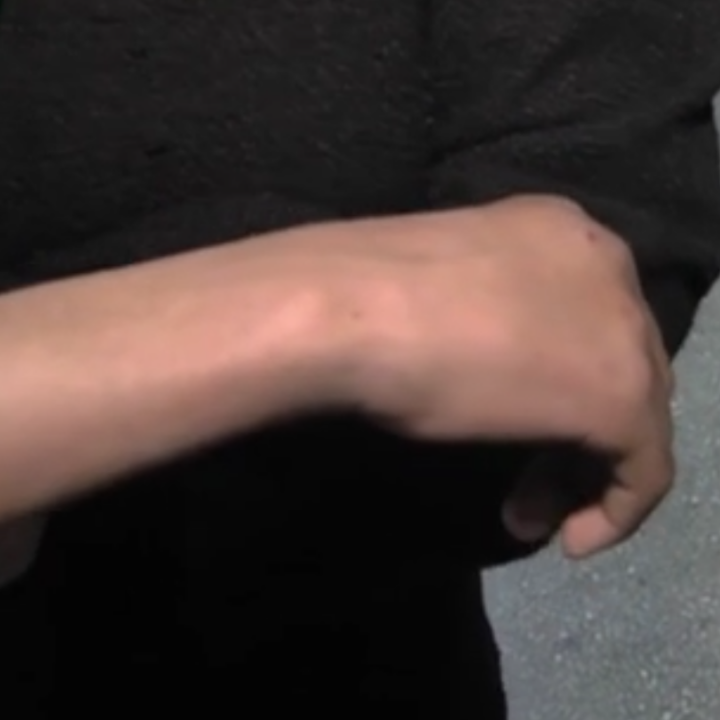 Битият седмокласник показва пораженията върху ръката си